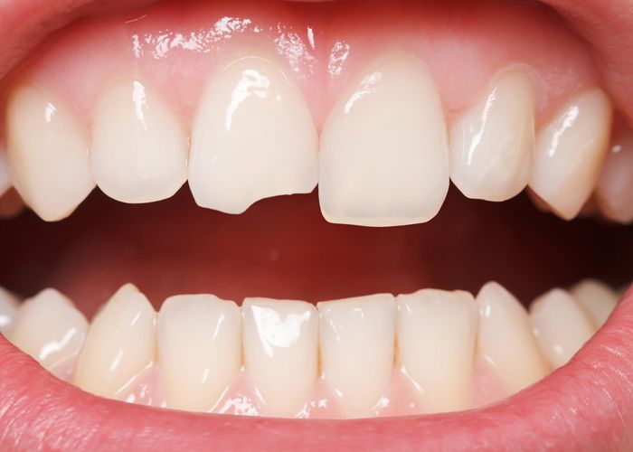 Chipped tooth in need of dental bonding.