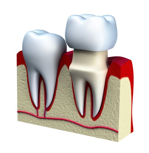 Digital illustration showing the components of a dental crown