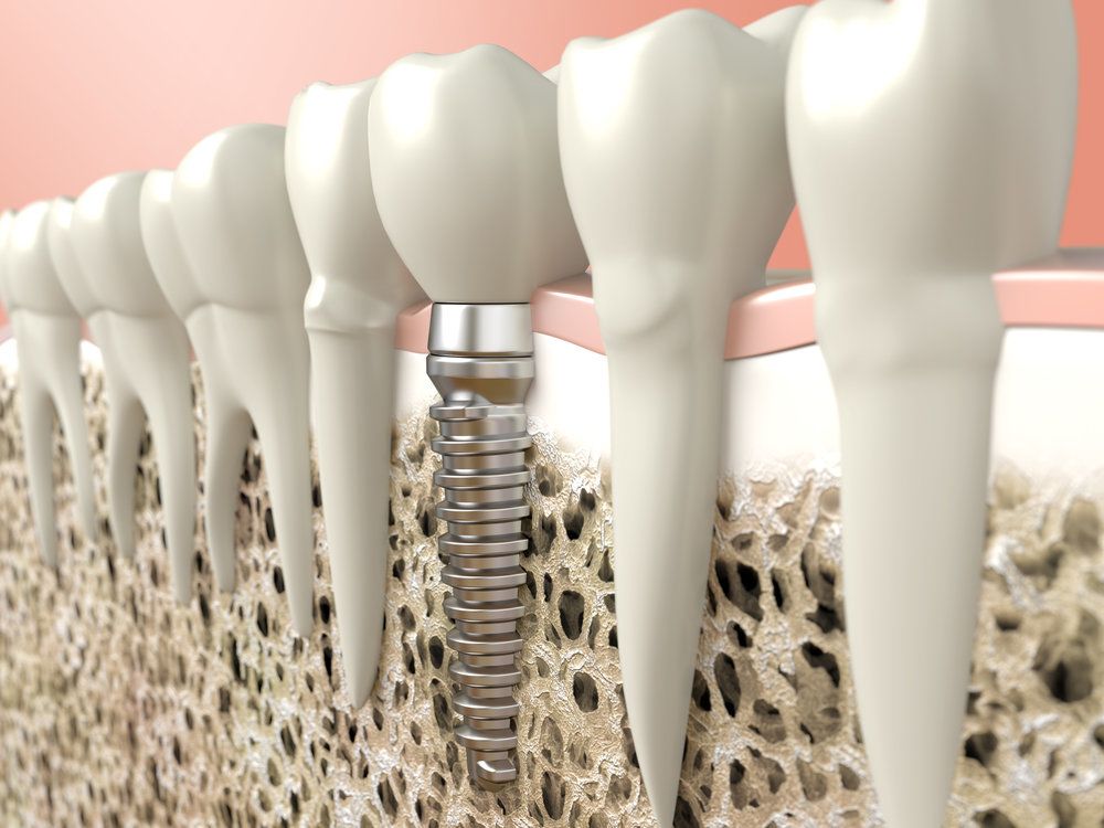 Digital illustration showing the location and components of an implant-supported crown