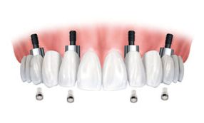 Illustration showing the components of an implant-supported denture