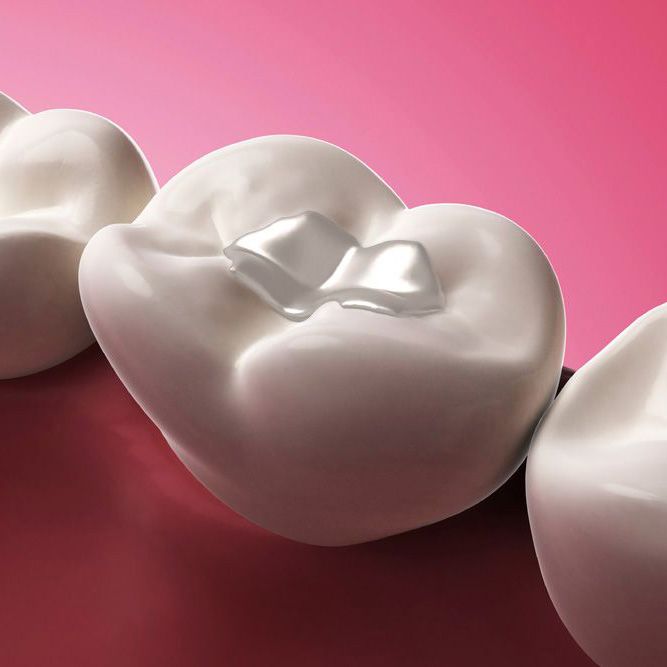 Digital illustration of a tooth-colored filling