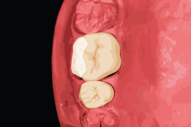 View of a model tooth with dental bonding material