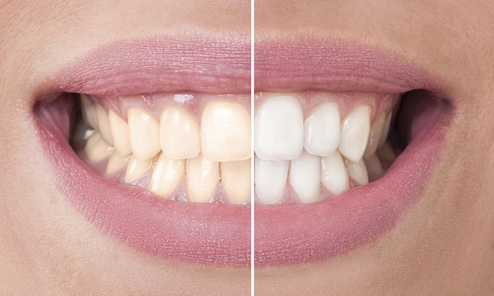 Before and after images of a teeth whitening patient